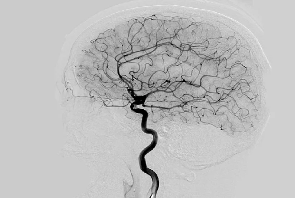 Cerebral Angioplasty