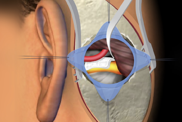 Microvascular Decompression MVD