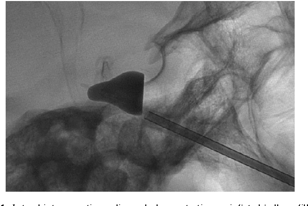 Percutaneous Balloon Compression PBC