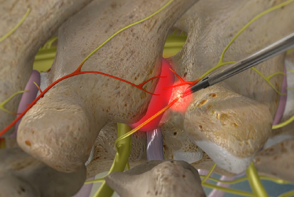 Radiofrequency Rhizotomy  Neurotomy