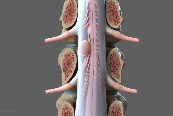 Spine Tumor